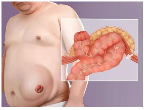 造口的严重后果——造口旁疝(图1) 造口的严重后果——造口旁疝(图1)