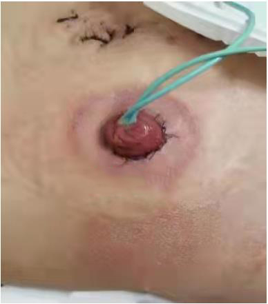 科普|如何让玫瑰绽放——如何护理泌尿回肠造口(图7) 科普|如何让玫瑰绽放——如何护理泌尿回肠造口(图7)