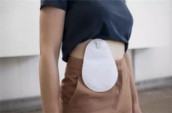 为什么不把肠造口从肛门带出,而是从腹部带出呢?(图1) 为什么不把肠造口从肛门带出,而是从腹部带出呢?(图1)