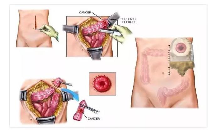 在中国,有100万人因肠癌失去肛门...医生也不能幸免(图2) 在中国,有100万人因肠癌失去肛门...医生也不能幸免(图2)