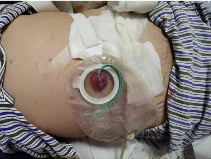 科普|如何让玫瑰绽放——如何护理泌尿回肠造口(图1) 科普|如何让玫瑰绽放——如何护理泌尿回肠造口(图1)