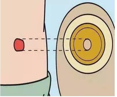 居家造口护理的那些事儿(图1) 居家造口护理的那些事儿(图1)