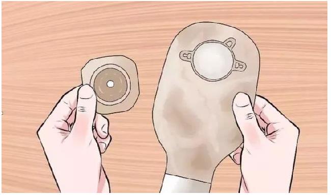 居家造口护理的那些事儿(图3) 居家造口护理的那些事儿(图3)