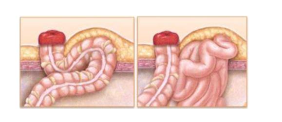 造口的严重后果——造口旁疝(图2) 造口的严重后果——造口旁疝(图2)