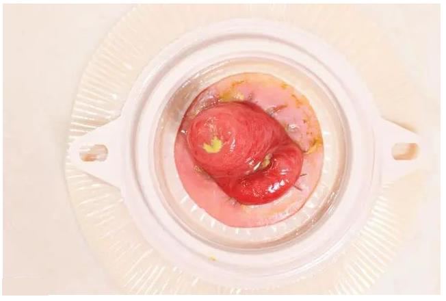 结直肠癌造口病人怎么吃?(图2) 结直肠癌造口病人怎么吃?(图2)