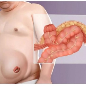 汪建平：减重手术降低肠癌风险