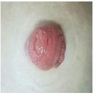 科普|如何让玫瑰绽放——如何护理泌尿回肠造口(图15) 科普|如何让玫瑰绽放——如何护理泌尿回肠造口(图15)