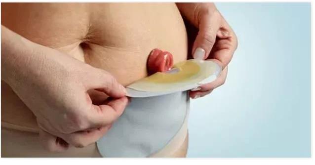 在中国,有100万人因肠癌失去肛门...医生也不能幸免(图3) 在中国,有100万人因肠癌失去肛门...医生也不能幸免(图3)