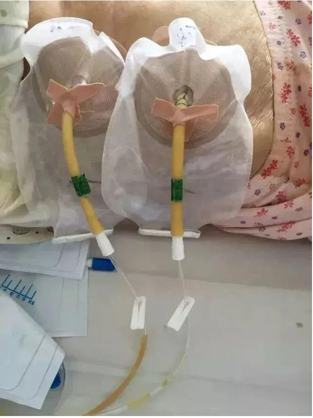 渗血、渗液、渗尿、漏粪?上造口袋啊!(图1) 渗血、渗液、渗尿、漏粪?上造口袋啊!(图1)