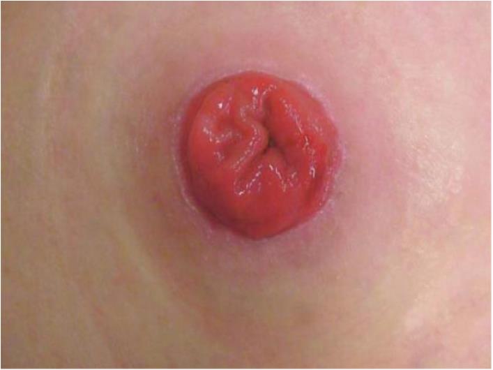 科普|如何让玫瑰绽放——如何护理泌尿回肠造口(图2) 科普|如何让玫瑰绽放——如何护理泌尿回肠造口(图2)