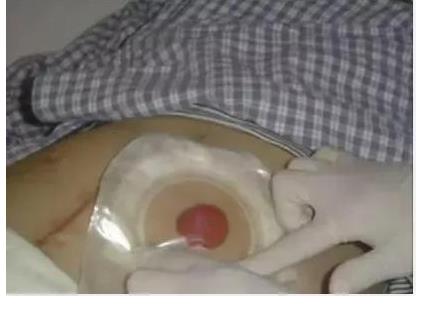 在中国,有100万人因肠癌失去肛门...医生也不能幸免(图5) 在中国,有100万人因肠癌失去肛门...医生也不能幸免(图5)