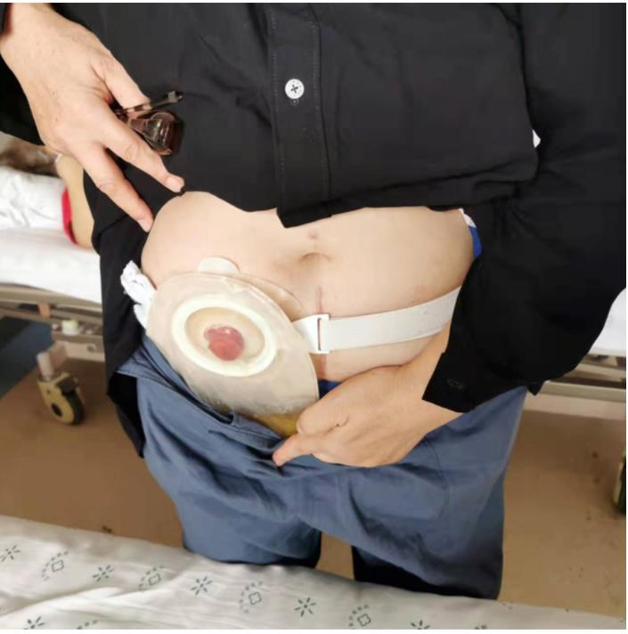 科普|如何让玫瑰绽放——如何护理泌尿回肠造口(图10) 科普|如何让玫瑰绽放——如何护理泌尿回肠造口(图10)