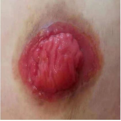 科普|如何让玫瑰绽放——如何护理泌尿回肠造口(图11) 科普|如何让玫瑰绽放——如何护理泌尿回肠造口(图11)